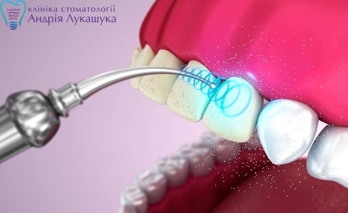 Пофесійна чистка зубів ультразвуком в Києві | Фото 3