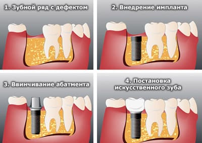 Фото одноэтапной имплантации зубов в стоматологии Лукашука в Киеве на Теремках