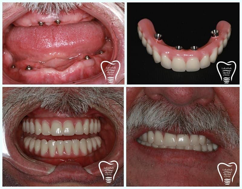 Мужчина получил новые зубы в клинике Лукашука