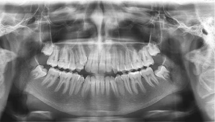 Прицельный снимок зуба | Фото 2