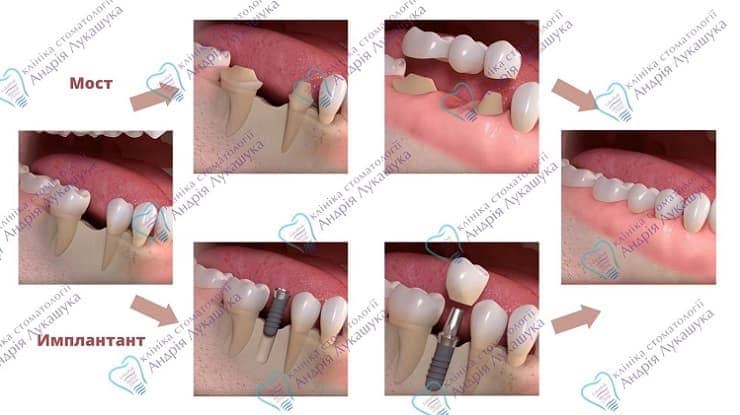 Протезирование зубов на имплантах | Фото 1