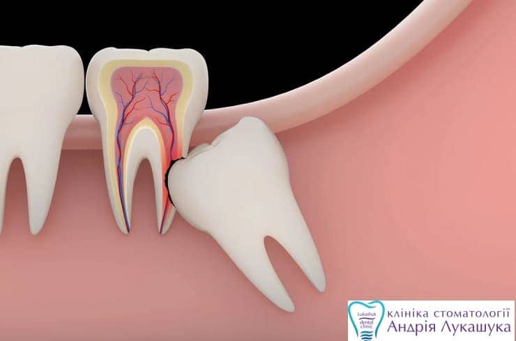 Удаление зуба мудрости | Фото 1 - Клиника Лукашука