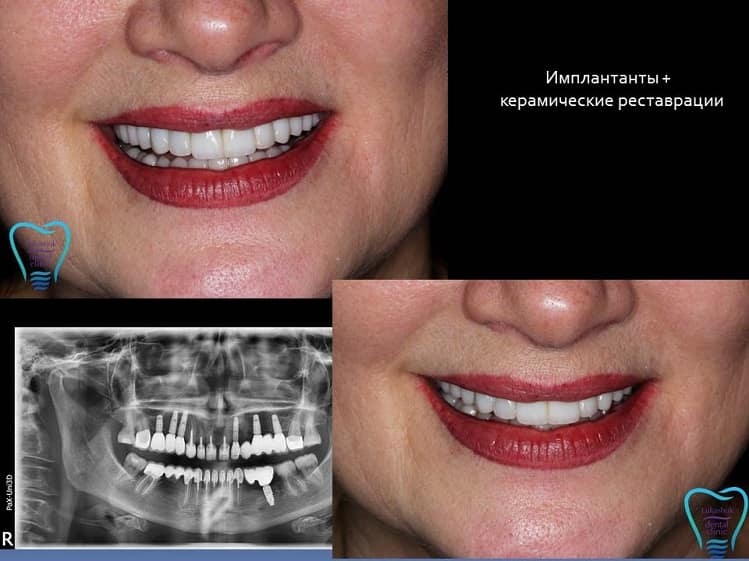 Имплантация зубов + керамические реставрации