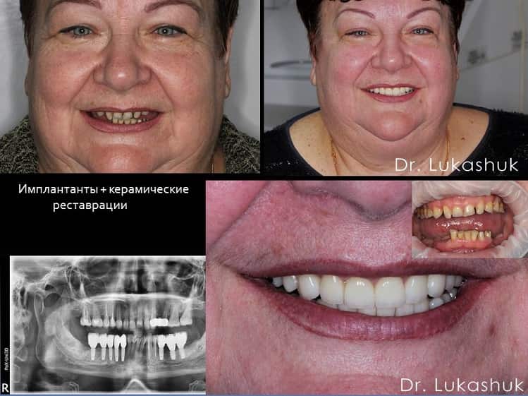 Имплантация зубов улучшает внешний вид