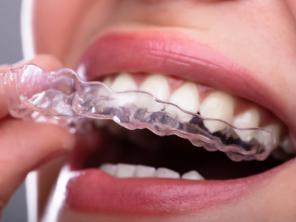 Брекети чи Елайнери – що краще вибрати для виправлення зубів?