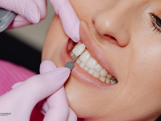 Что лучше — виниры или люминиры: честное сравнение