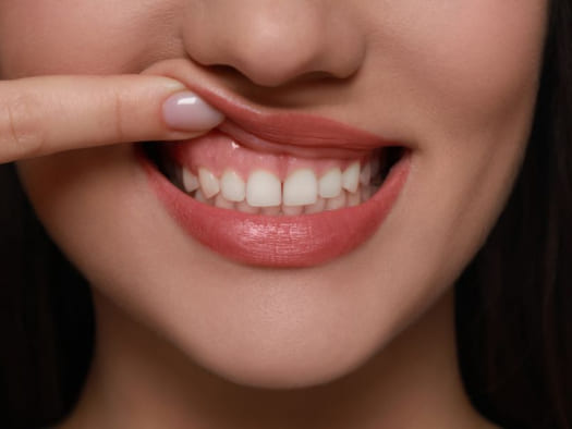 Коррекция десневой улыбки в стоматологии