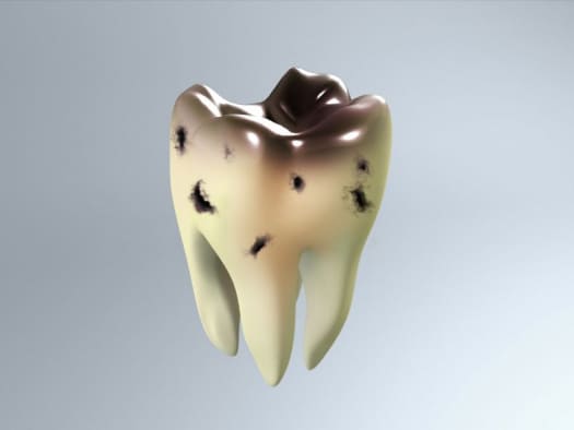Почему гниют зубы, причины, стадии и лечение