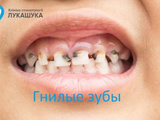 Почему гниют зубы, причины, стадии и лечение