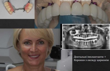 Что такое зубной имплант