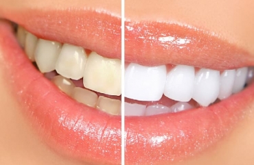 Как отбелить зубы? Что лучше: полоски, каппы или профессиональное отбеливание?