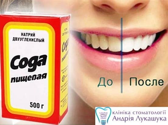 Как отбелить зубы содой | Фото - Клиника Лукашука