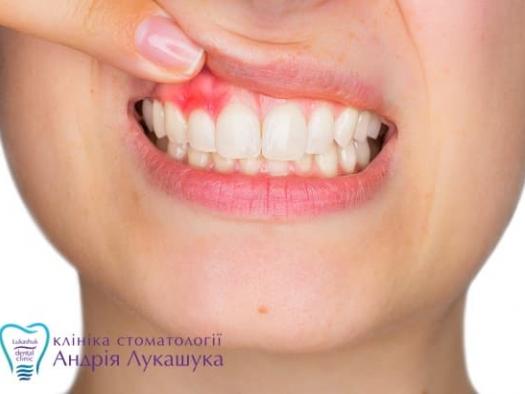 Киста зуба: причины, симптомы и методы лечения