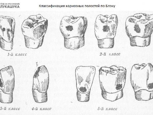 Классификация кариозных полостей по Блэку