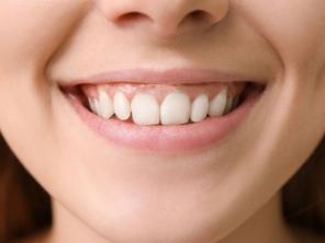 Корекція ясенної посмішки у стоматології