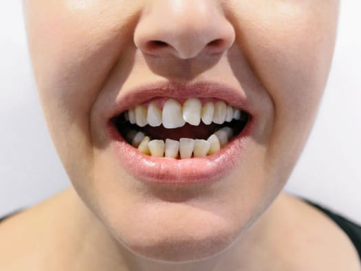 Как исправить кривые зубы?