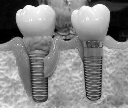 Отторжение зубного импланта: основные симптомы и признаки