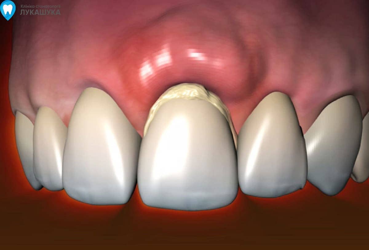 Почему сильно зуб. Периостит челюсти (флюс). Гипопластический гингивит.