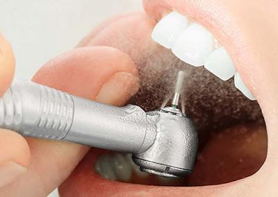 Профгигиена полости рта или как не переплачивать стоматологу