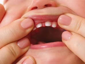 Ріжуться зуби у дитини – які зуби лізуть перші