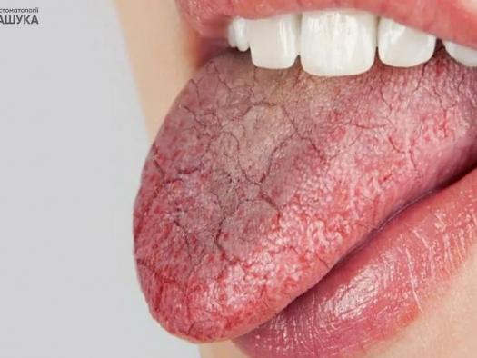 Сухість у роті: основні причини, симптоми та лікування