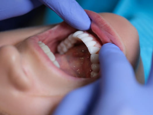 Вініри на криві зуби: як встановлюють і чи можна це робити