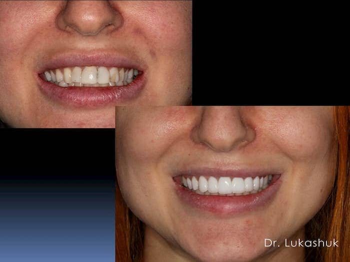 Можно ли поставить виниры если нет зубов | Фото 1 - Клиника Лукашука