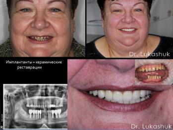 Імплантація зубів в Клініці Лукашука