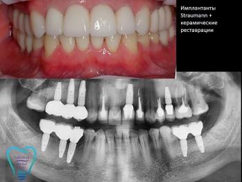 Імплантація зубів в Києві