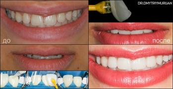 фото зубів до та після лікування