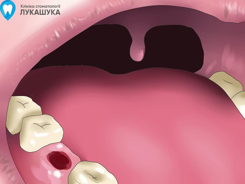 Альвеоліт після видалення зуба | Фото 1 - Клініка Лукашука