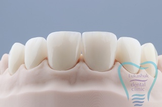 Какие коронки на зубы лучше ставить | Фото 3 - Клиника Лукашука