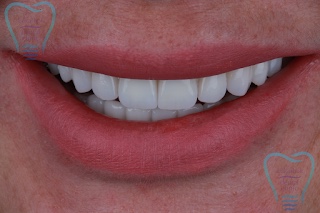 Какие коронки на зубы лучше ставить | Фото 1 - Клиника Лукашука