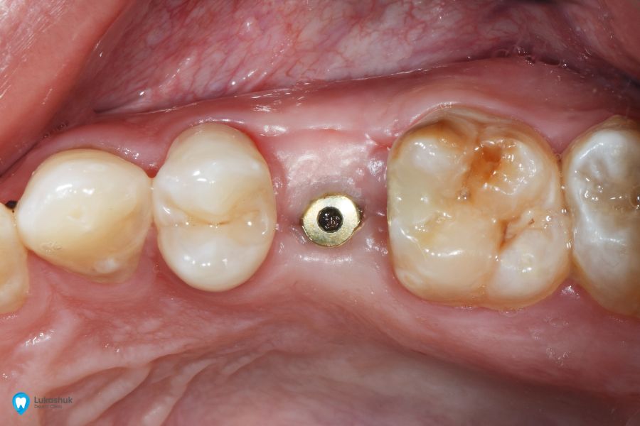 Поведение организма по отношению к зубным имплантам