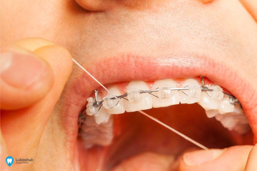 Флосс для чистки зубов с брекетами | Фото 4