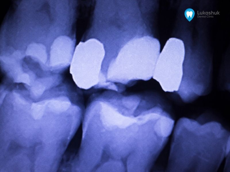 Пломба зуба на рентгене