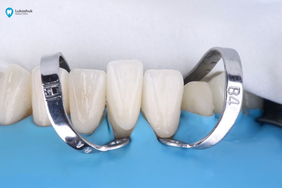 Відбілювання зубів вінірами у клініці Лукашука | Фото 4