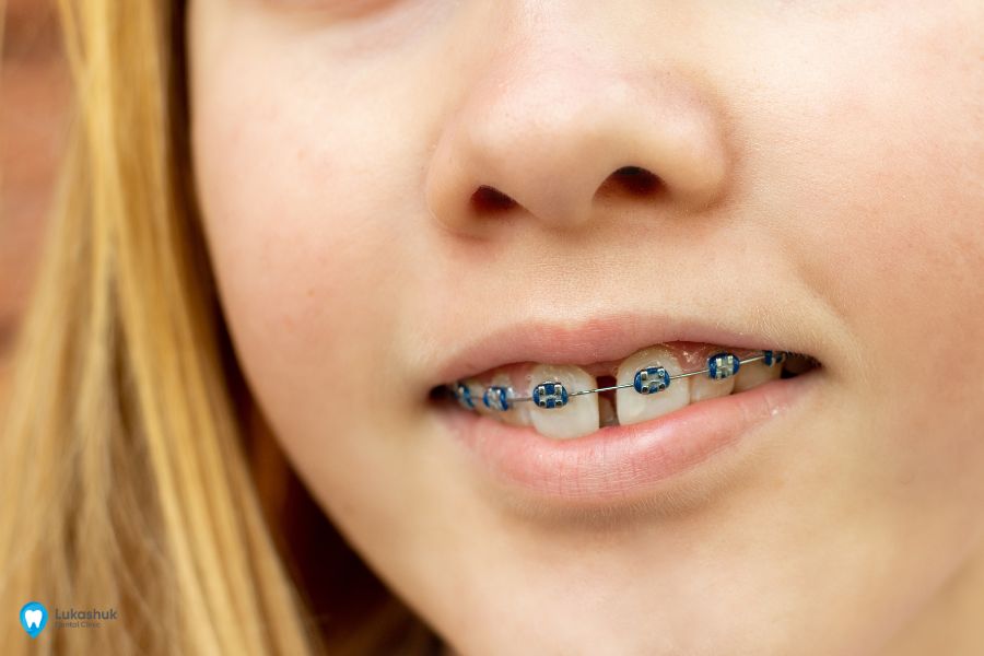 Щілини між зубами у дітей