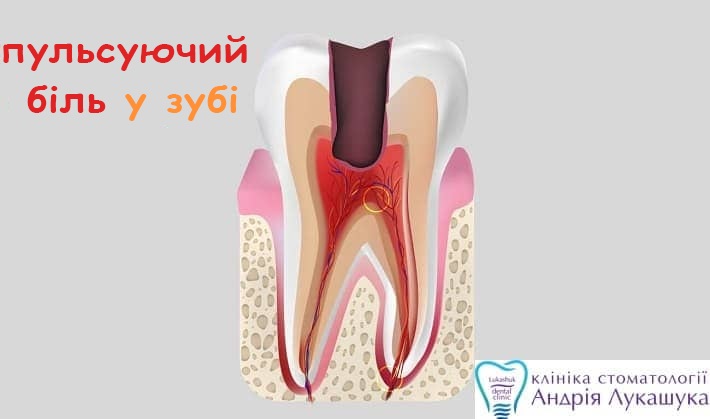 Біль у зубі