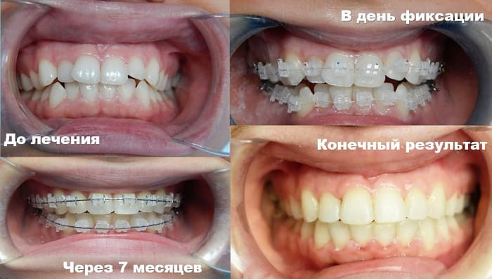 Исправленная асимметрия челюсти: как изменятся черты лица?