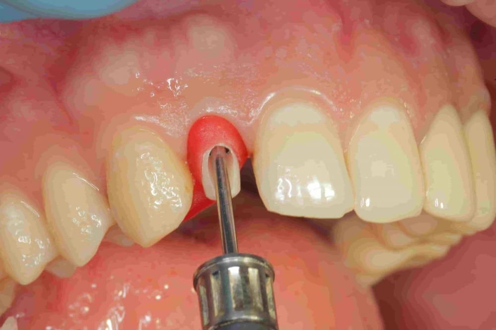 Одномоментная имплантация зубов | Фото 2 - Клиника Лукашука