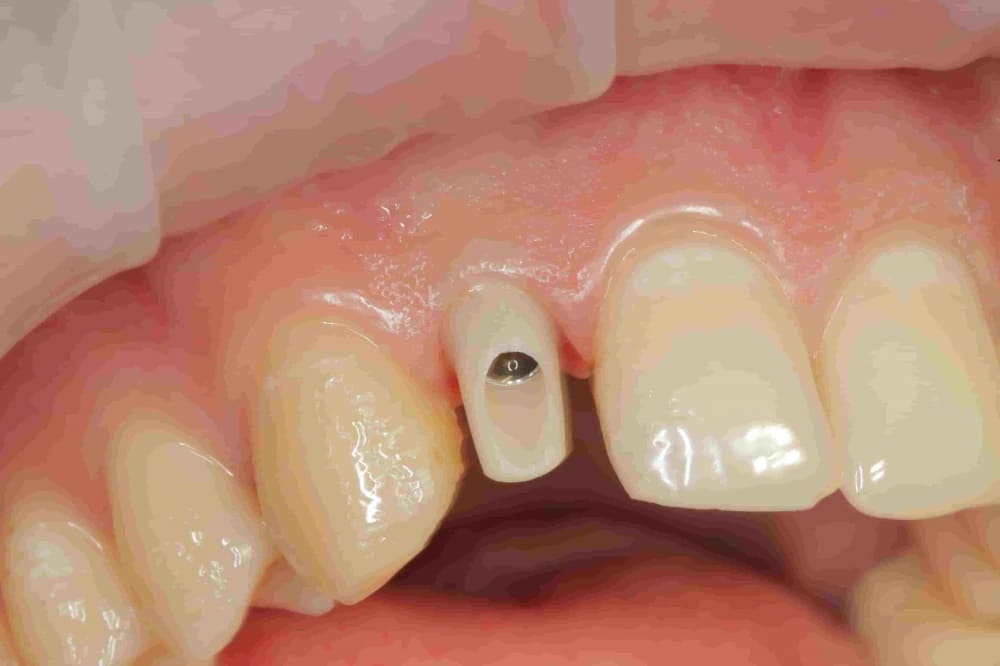 Одномоментная имплантация зубов | Фото 3 - Клиника Лукашука