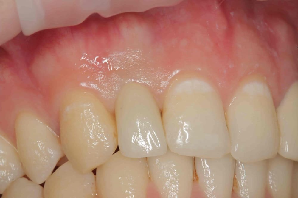 Одномоментная имплантация зубов | Фото 4 - Клиника Лукашука