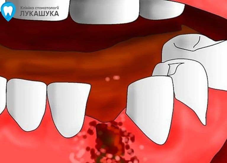 Альвеоліт після видалення зуба | Фото 2 - Клініка Лукашука