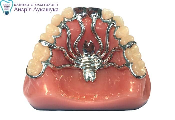 Бюгельне протезування зубів - Клініка Лукашука
