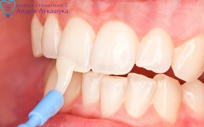 Нанесение специальной маски для укрепления зубной эмали - Клиника Лукашука
