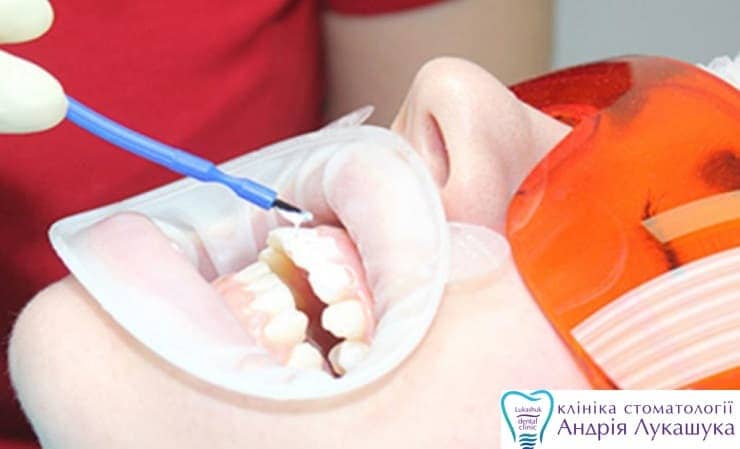 Фторирование зубов | Фото 2 - Клиника Лукашука