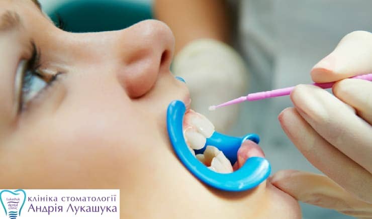 Фторирование зубов | Фото 1 - Клиника Лукашука