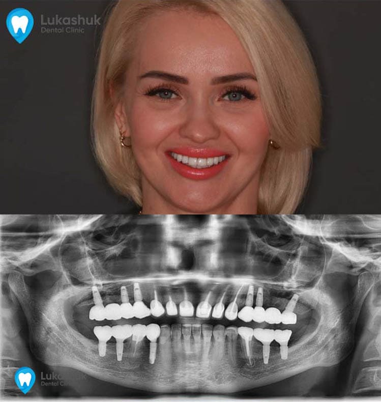 Посмішка жінки після імплантації