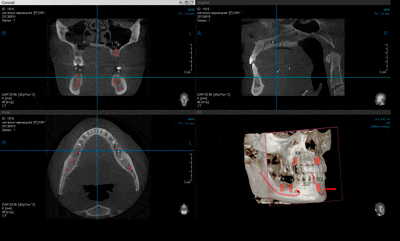 Комп'ютерна томографія перед імплантацією | фото 1